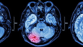 Traumatic Brain Injury